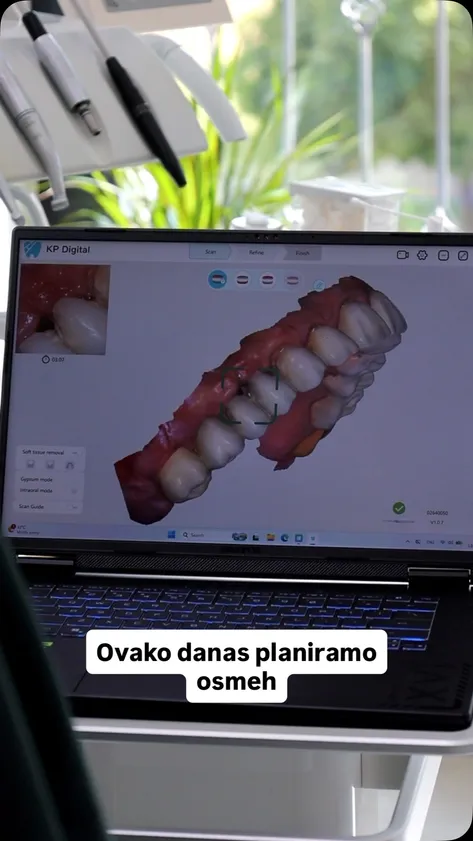 Trodimenzionalni snimak zuba iz intraoralnog skenera na ekranu laptopa